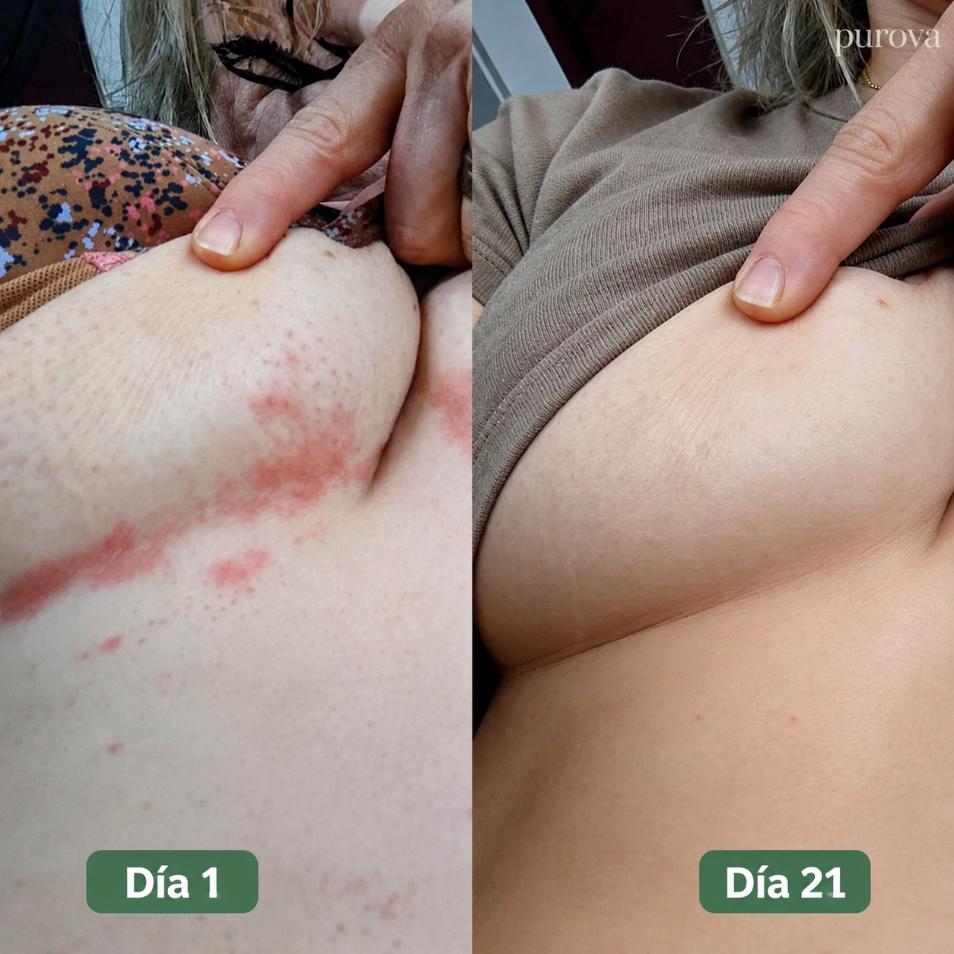 Crema para Pliegues™ | Alivia la irritación y el ardor en minutos