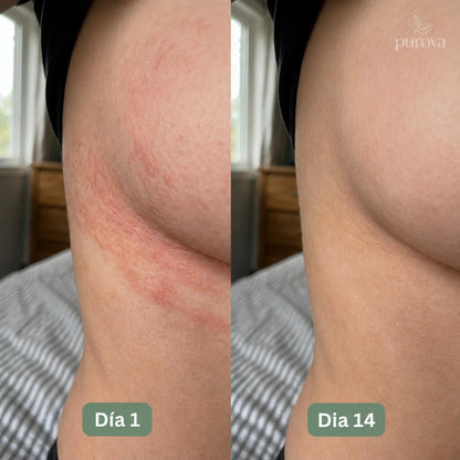 Crema para Pliegues™ | Alivia la irritación y el ardor en minutos