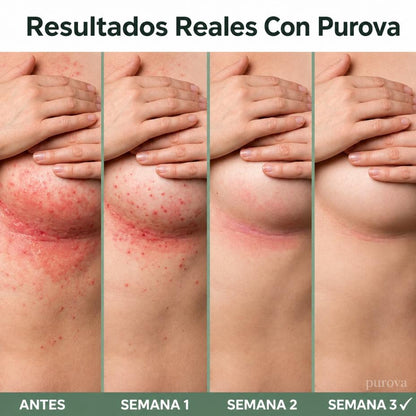 Crema para Pliegues™ | Alivia la irritación y el ardor en minutos