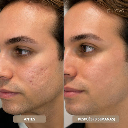 Barra reparadora de marcas de acné